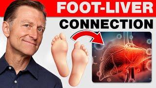 How Your Feet Are Warning You About Your Liver Problems - Dr. Berg Explains