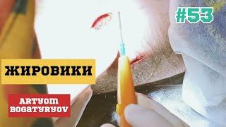 Удаление жировиков #53