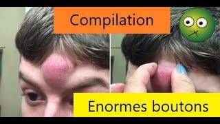 Compilation : Gros bouton / Big pimple 2020