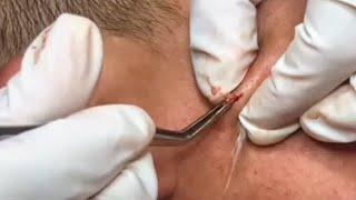 Satisfying Cyst & Blackhead Removal | Mesmerizing Extraction