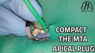 Using Bond Brush to Compact the MTA Apical Plug | EndoTactics