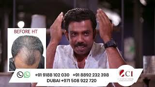 Hair Transplantation done by Malayalam Cine artist Azees Nedumangad