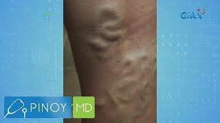 Pinoy MD: Varicose veins, paano malulunasan?