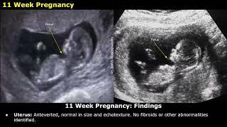 Obstetric Ultrasound Reporting | How To Write USG Reports | Pregnancy Sonography | TIFFA Scan