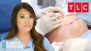 Biggest Removals Ever | Dr. Pimple Popper | TLC