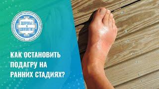  Как остановить подагру на ранних стадиях?