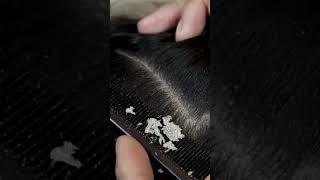 dandruff scratching addiction #101