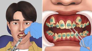 Process of Getting Braces (3D Animation) #shorts #youtubepartner