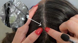ASMR- Professional SCALP Cleansing‍️ #microscope #scratching #dandruff #relaxing