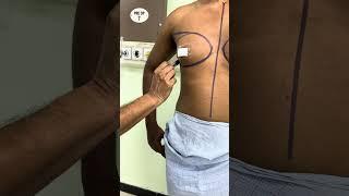 What is the aim of gynaecomastia surgery?