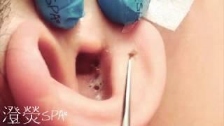 日常耳朵黑頭清理  Satisfying ear blackhead cleaning video