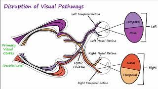 Visual Neural Pathways and Visual Field Defects