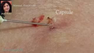 Josefa: Removal of a Sebaceous Cyst (gigantic blackhead)