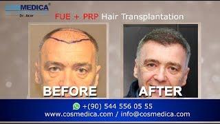 COSMEDICA DR.ACAR ,3000 Grafts  FUE Hair Transplant,Turkey-Istanbul