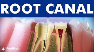 ROOT CANAL treatment step by step  - 3D video of endodontics for tooth decay ©