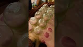 [ASMR] 拔罐- 按摩 - Cupping Therapy #asmr #cupping #china #therapy