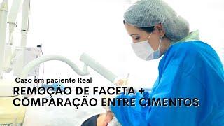 Lentes de Contato Dental || Feita em Dentista || Remoção de Lentes || Caso Real