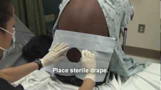 Adult Spinal Tap Procedure Video