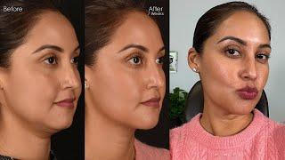 Julia's Facial Slimming Results | Deep Neck Liposuction, Buccal Fat Removal & Fat Transfer to Face