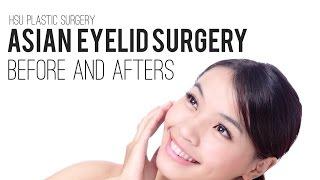 Asian Eyelid Surgery Patient Before and Afters