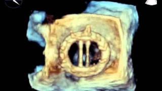 3D Echocardiogram of Prosthetic Mitral Valve