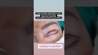 Double Eyelid Surgery | Blepharoplasty | Upper eyelid surgery | Asian eyelid surgery #shorts