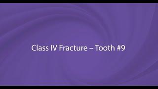 OMNICHROMA Procedure Video with Dr. Kevin Brown: Class IV Fracture, Tooth #9, with Mylar Strip