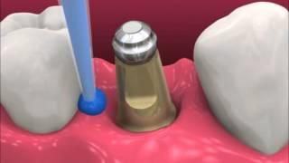 Smyl Manatee - Dental Implant Procedure