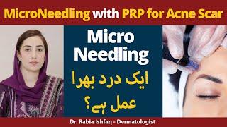 Microneedling With PRP For Acne Scars [ Is It Painful Procedure?] | Microneedling Kya Hota Hai?