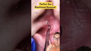 Worlds Most Satisfying EAR BLACKHEAD REMOVAL #shorts