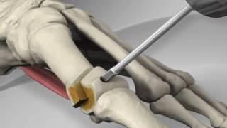 First Metatarsal Distal Chevron Osteotomy with Arthrex® LPS Screw