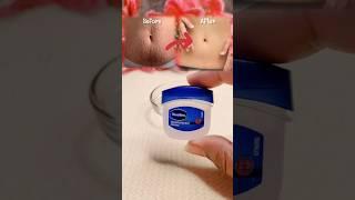 Stretch Marks Removal Cream at Home  #viral #stretchmarks #skincare #stretchmarkscream #shorts