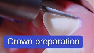 Two-plane preparation for a crown without undercuts