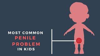 Common penile problems in boys|Children's Health | Healthcare | Knowmadic
