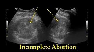 Incomplete Abortion || Ultrasound || Case 25