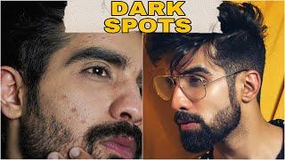 Remove DARK SPOTS NATURALLY| ACNE SCARS, HYPERPIGMENTATION, BLACK SPOTS, ACNE MARKS | HINDI| #shorts