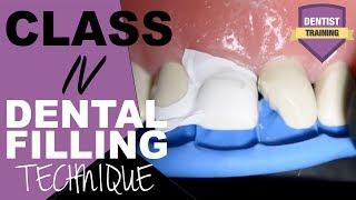 Class IV Composite Filling Tutorial | Front Tooth Filling