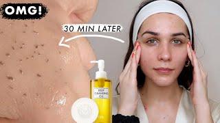 I'VE TRIED OIL CLEANSING for 30 minutes and this is what happened  SO MANY OIL PLUGS...