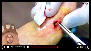 CRAZY FOOT OBJECT REMOVAL ***UNBELIEVABLE*** #toebroclip