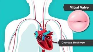 Understanding Heart Murmurs, Aortic and Mitral Valve Problems