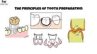 Principles of tooth preparation