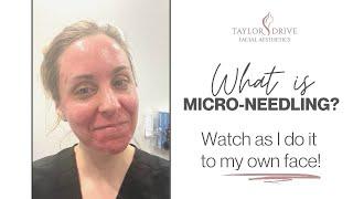 What is microneedling?