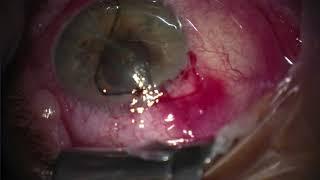 removal of eroded Xen; preserflo implantation in eye with fragile conjunctiva + corneal neovasc.