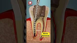 Root Canal Treatment 3D Animation #shorts
