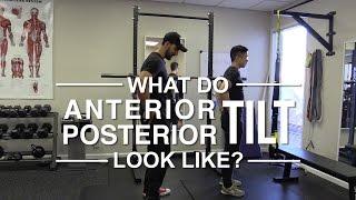 What does anterior pelvic tilt look like? What does posterior pelvic tilt look like?