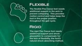 Foot Type: Pes Cavus (High Arch)