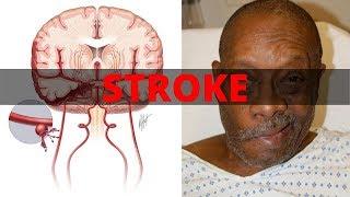 Assessment and Treatment of Stroke