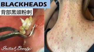 背部黑頭粉刺(blackheads on back) - Taiwan Tainan台南清粉刺最乾淨