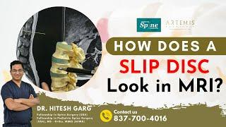 How Does A Slip Disc Look In MRI? Best Slip Disc Doctor India | Microscopic Slip Disc #drhiteshgarg