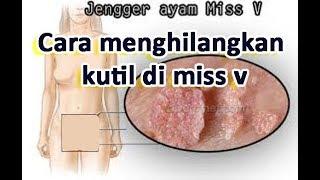 INILAH Cara menghilangkan kutil di miss v secara herbal